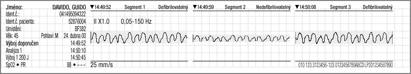 Správa dat Viz Obr. 6-2 s příklady rozložení tisku dat křivek ve zprávě SOUHRN UDÁLOSTÍ. Jméno: DAVIDO, GUIDO Ident.č.: 041495094322 Ident.č. pacienta: 52876004 Umístění: BF382 Věk: 45 Pohlaví: M24.