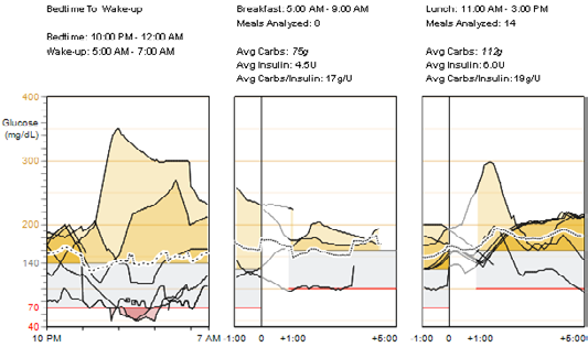 Glucose Sensor Overlay Bedtime to Wake-up and Meal Periods Readings and Averages (Porovnání hodnot glukózy naměřených senzorem doba od ulehnutí ke spánku po probuzení a doba jídla naměřené hodnoty a
