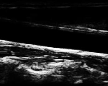 extraction SVM classifier Artery points selection RANSAC method px features