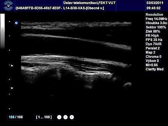 5 /18 /52 SPLAB, BUT Klepnutím The common lze upravit carotid styl artery předlohy (CCA) Source of important information Doctors can use it to evaluate the patients health Can be measured