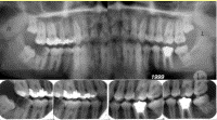 Existuje několik metod zjištění totožnosti podle zubů, vždy je však nutné srovnat zjištěné údaje se záznamy. Jeden z příkladů biometrické identifikace zubu je na Obrázku č. 45. Obrázek č.