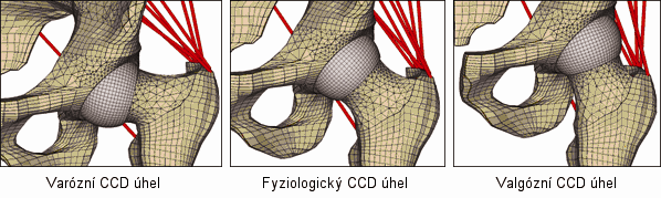 Výsledky výpočtového modelování citlivostní analýzy Vliv kolodiafyzárního úhlu na napětí v krčku, na
