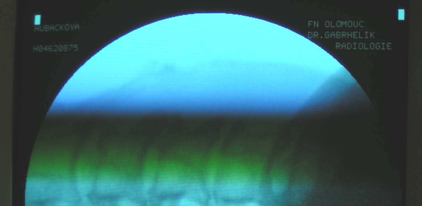 RF krčních facet Lord, 1996-12