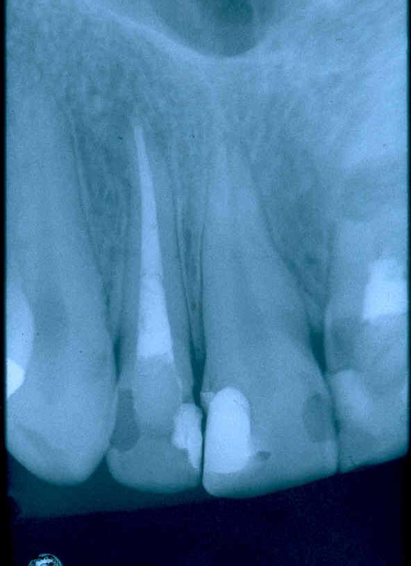 Periodontitis chronica