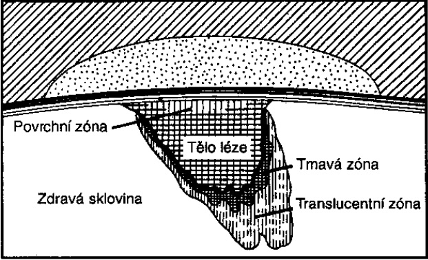 U zastavené léze dochází často k hnědavému zabarvení povrchu. Zbarvení vznikají během remineralizačních fází ukládáním exogenních barviv, např.