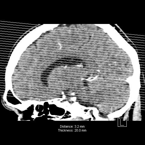 CT perfuze mozku Časné stanovení