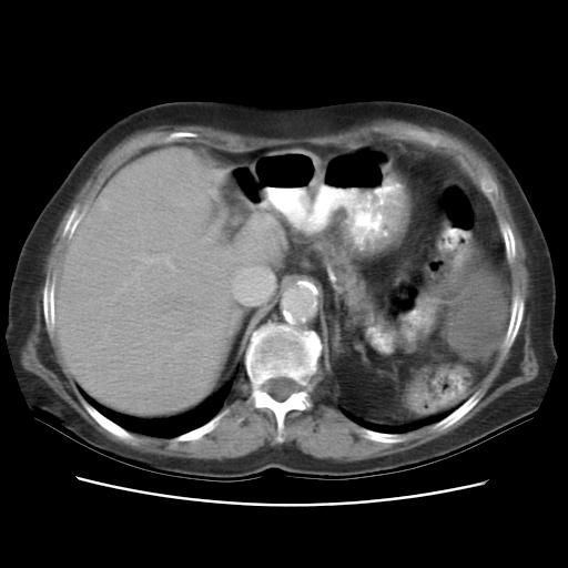 Hodnocení efektu dle CT CT scan