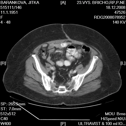multiple liver, peritoneal and
