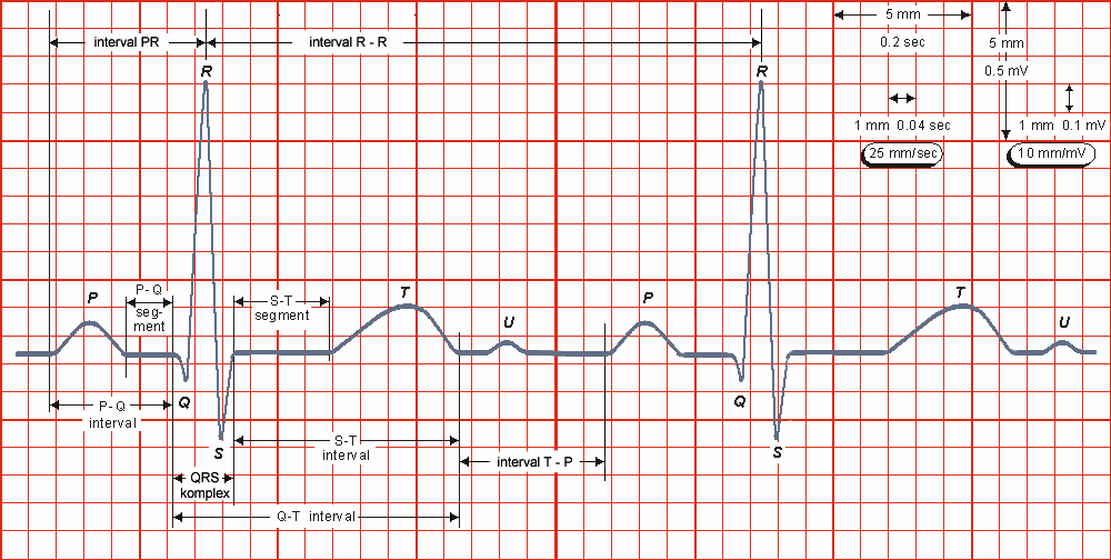 2.3. Křivka EKG Normální elektrokardiogram se skládá z pravidelně se opakujících pozitivních a negativních kmitů a vln, které odpovídají potenciálovým změnám v jednotlivých částech myokardu.