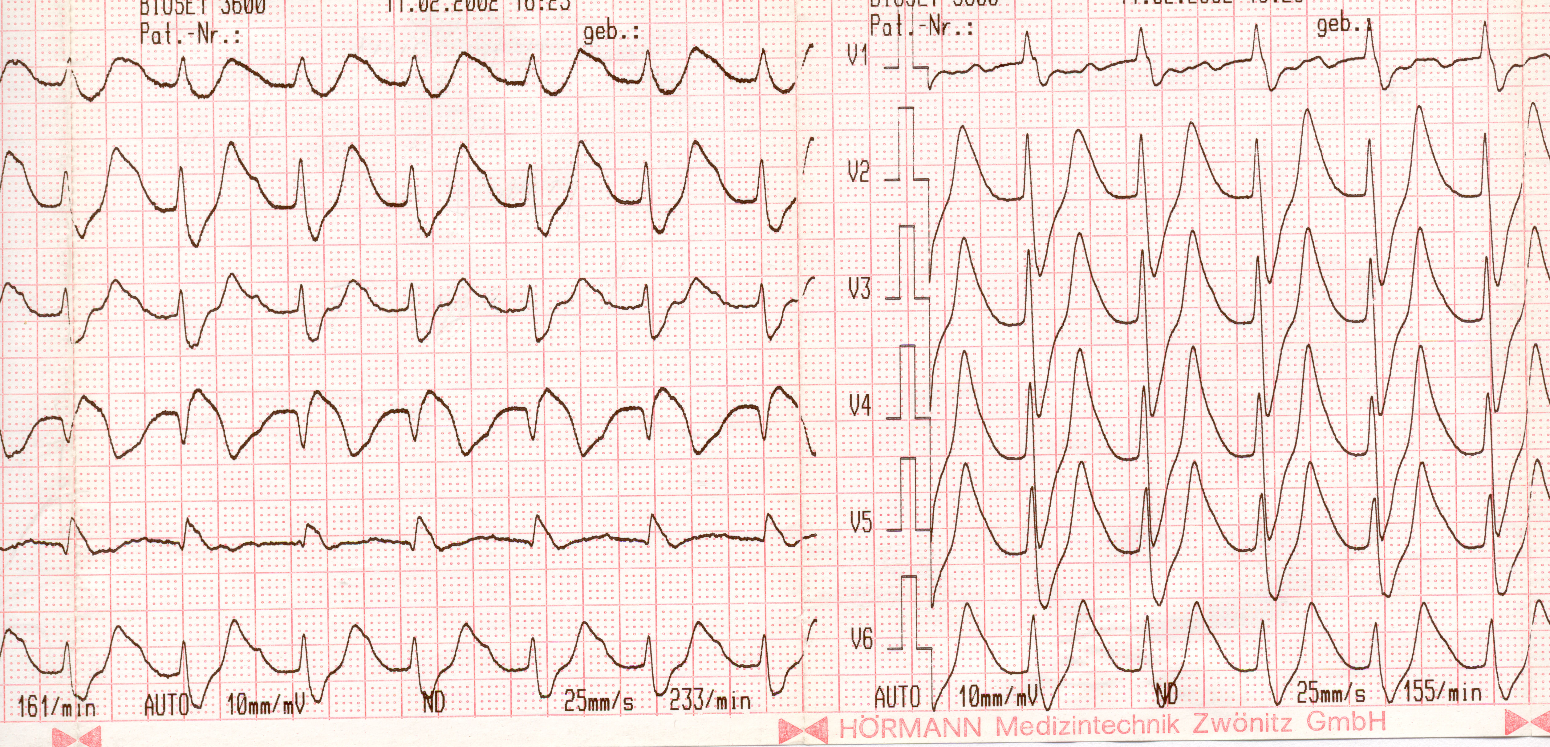 Šířka kmitů QRS rozšíření