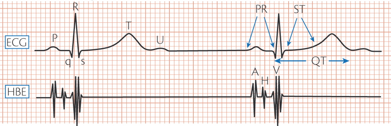 Časové intervaly Interval P Q = 0,12-0,20 s. Komplex QRS pod 0,10 s. Úsek ST je izoelektrický interval mezi 0,1 0,15 s.