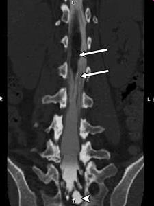 Výsledek vyšetření CT myelogram Šipka ukazuje na intramedulární