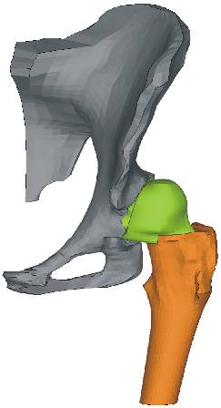 Výpočtové modelování Model geometrie patologického kyčelního kloubu Vytvoření geometrického modelu patologického kyčelního