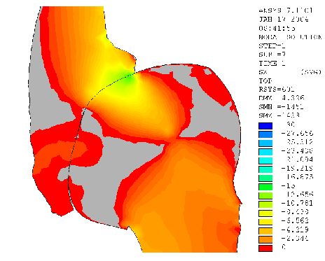 glutaeus pmax = 30,7 MPa pmax = 30,7 MPa Kontaktní tlak na chrupavce acetabula (pohled shora)