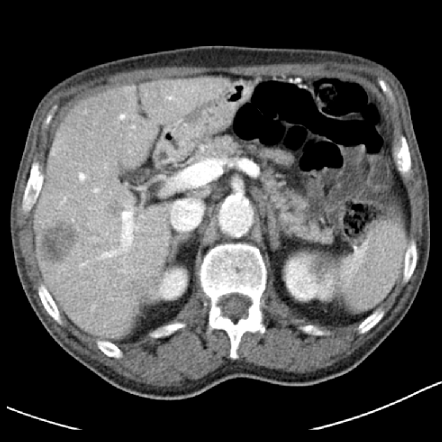 Obr.9: Metoda LoG, hypodensní tumor, škálování 0:10, práh 20