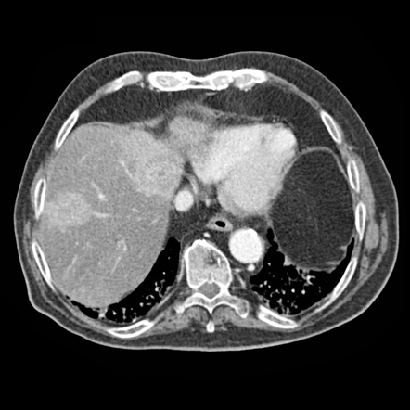 all Obr.16: MSER, hypodensní tumor, min. diversita 0.8, max. variace 0.