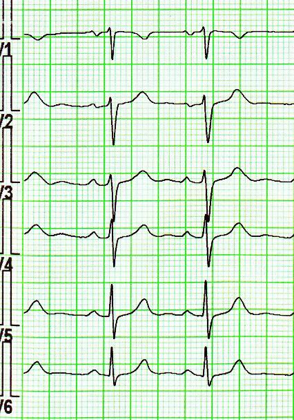 EKG sinusový rytmus I II III