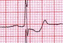 Co hledat na EKG při pátrání po známkách AIM Elevace či deprese ST úseků, vždy dva svody - STEMI AIM s elevacemi ST