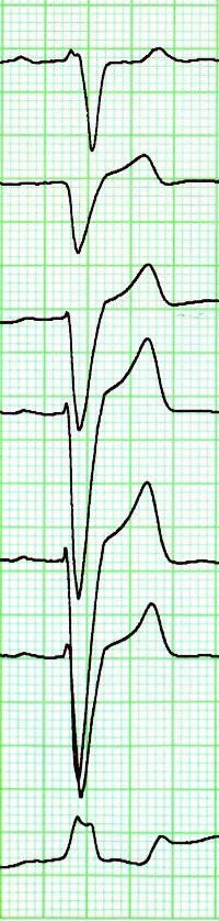 LBBB NORMA RBBB V1 V2 V3