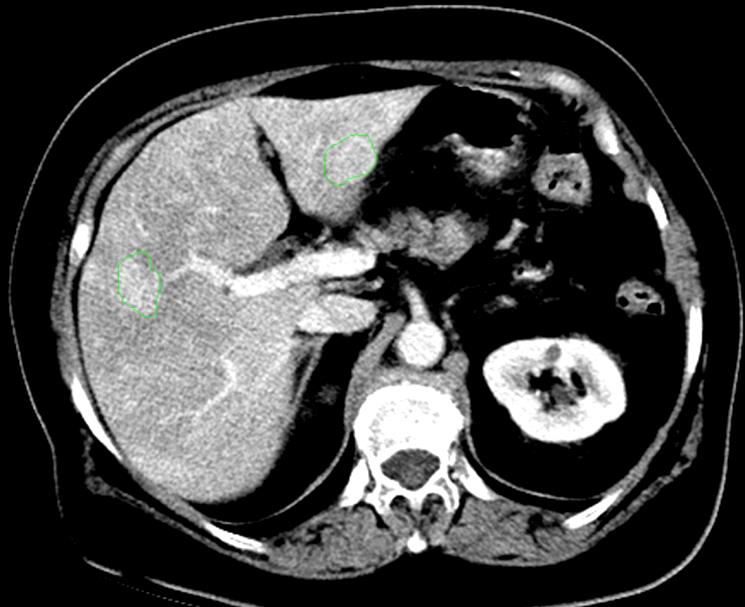 2 roky po nasazení Sandostatinu LAR CT 6/2011 Stabilizace klinická i