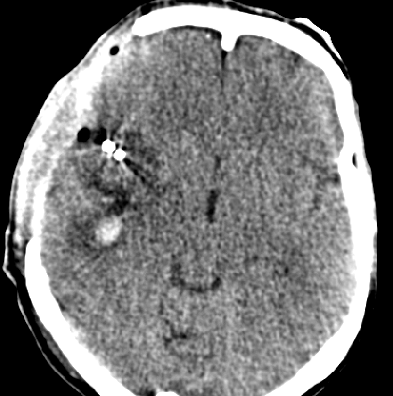 Obrázek č. 5: KAZUISTIKA Č.2 Pooperační CT mozku Zdroj: WinMedicalc FN Plzeň Lochotín Obrázek č.