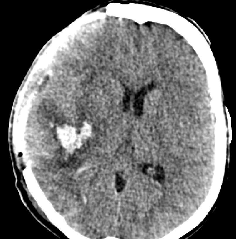 Obrázek č. 6: KAZUISTIKA Č.2 Pooperační CT mozku Zdroj: WinMedicalc FN Plzeň Lochotín Obrázek č. 6: Pooperační CT mozku. Transverzální řez.