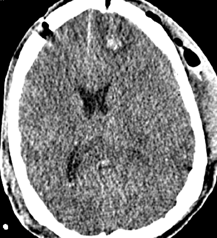 Obrázek č. 13: KAZUISTIKA Č.6 Pooperační CT mozku Zdroj: WinMedicalc FN Plzeň Lochotín Obrázek č.13: Pooperační CT mozku. Transverzální řez.