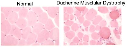 Duchennova muskulární dystrofie (DMD) - X-vázané, recesivní, svaly vyčerpávající nemoc, ovlivňující asi 1 z 3 300 živě narozených chlapců - Nástup je mezi 4-5 rokem života - Svalová slabost v bocích,