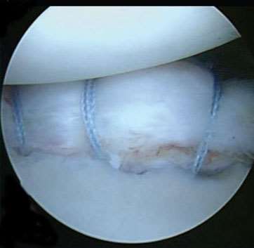 Operace Debridement,