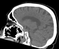 Enthorhinální cortex Perirhinální cortex Někdy se ale neprovede ani CT!