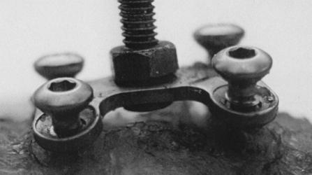 Z obrázku 2.2.1.1 b) jsou patrné dva podstatné rozdíly mezi uni a bi-kortikálními fixátory typu H destička. První spočívá v kotvení šroubů v destičce.