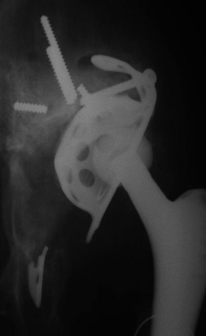 2.4 Biomechanické problémy u kovových aloplastik se zhoršenou kvalitou kostní tkáně 2.4.1Biomechanická studie namáhání TEP Burch Schneiderovy dlahy Název publikované práce: Biomechanická studie namáhání TEP Burch Schneiderovy dlahy 2.