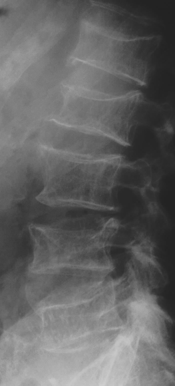 Prevence Vertebral