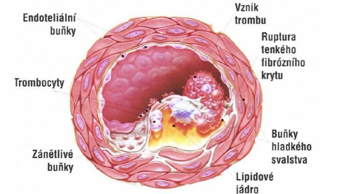 Patofyziologie nestabilní angíny pectoris / IM * podkladem stenózy je nestabilní aterosklerotický plát : - slabá a křehká vazivová čepička - velké lipidové jádro - vysoký obsah zánětlivých buněk *