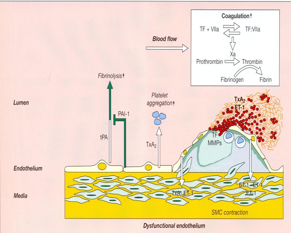 faktory IL-4, IL-10 TGF β TIMP Kalcifikace plátu Topol JE, Atlas of Atherothrombosis, 2005 Vysvětlivky: IL interleukiny; INF γ interferon γ; Lp-PLA2 - fosfolipáza A2