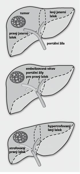 Regenerace jater a jaterní