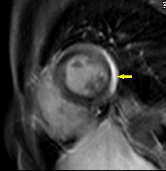 NMR/CT (CT) koronarografie (SKG neg.