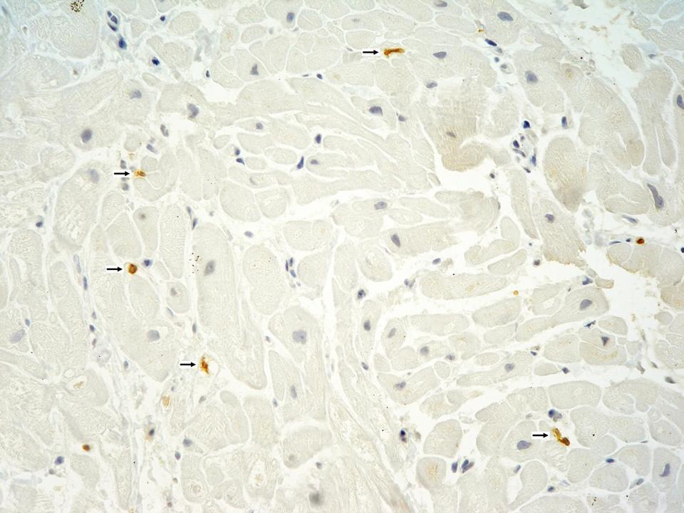 Imunohistochemie Leukocyty 14/mm 2 CD 3+ T lymfocyty 7/mm 2, CD 68+