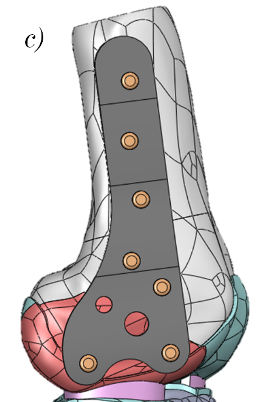 kolena s použitou dlahou a vruty je na obrázku 717, z detailu je vidět, že v modelu je uvažováno použití dlahy jako úhlově stabilní, dlaha není v kontaktu s kostní tkání Zbylé dvě varianty jsou na