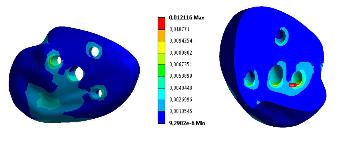 přetvoření v těchto oblastech má lokální, časové omezený charakter, který významně neovlivní remodelaci kostní tkáně Obrázek 924: Fragment spongiózní kostní tkáně, varianta F 1-3 -