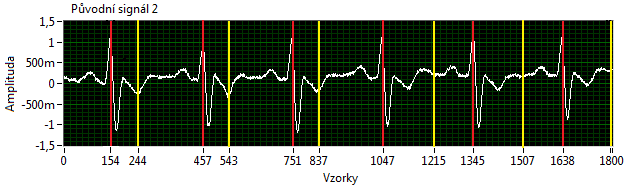 Obr. 5.2.6.1: Konce T vln, 3. pozice za R vlnou Na obr. 5.2.6.1 je vidět, že správně detekované jsou až poslední tři konce T vln na pozicích 1215, 1507 a 1793.