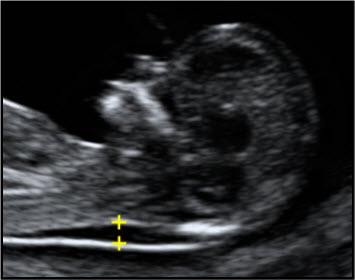 tekutinou (viz Obrázek 1.3) [3], [10]. Provádí se více měření a jako výsledek se bere nejvyšší hodnota NT [10].