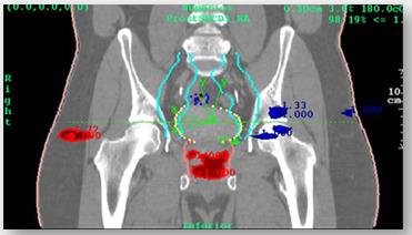 3D možnosti verifikace dnes Software pro (in vivo) EPID dozimetrii Dosimetry Check (Math Resolutions, Standard