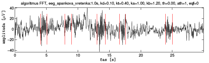 EKG Popis