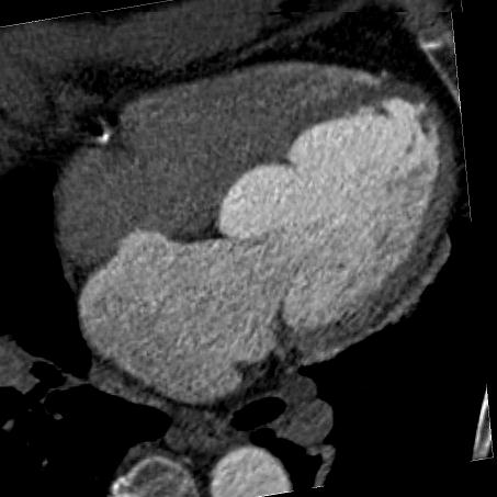 Počítačová tomografie Neinvazivní vyšetření, ale radiační zátěž přesné hodnocení