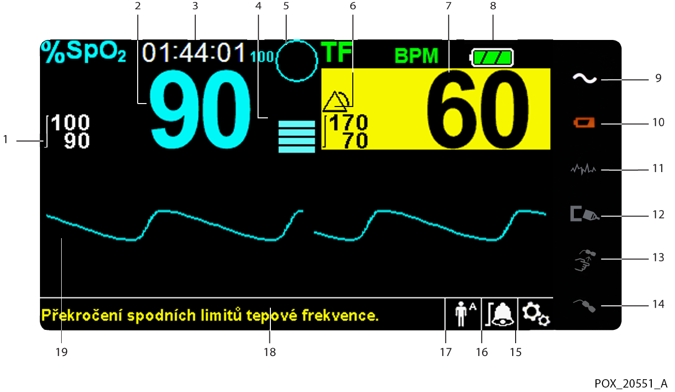 Přehled výrobku 8 Displej LCD Slouží k zobrazení všech informací o pacientovi v grafické i numerické podobě, všech souvisejících stavů a varovných hlášení.