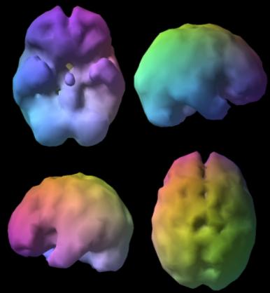 Zde můžeme pozorovat mozky čtyř lidí. 5. Příloha SPECT snímky mozku ORB Normal 40 yo ORB AT AT ORB ORB AT AT Normal 80 yo Vlevo nahoře vidíme mozek čtyřicátníka, nekriminálního, tzn.