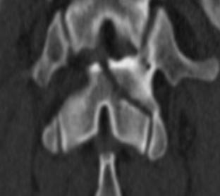 B posterior tension band injury B1 Chanceho fraktura transoseální Monosegmentální, čistě kostní Horizontální fraktura předních i zadních