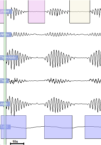 Obrázek 19: Typická ukázka periodického dýchání. Na obrázku není tento úsek vyznačen, ale jedná se o záznam kanálu Abdo. Modrou barvou je označena desaturizace na kanále SpO2. 6.3.