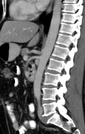Dunbarův syndrom Median arcuate ligament compression Coeliac axis syndrom V 10-24% ligamentum ventrálně
